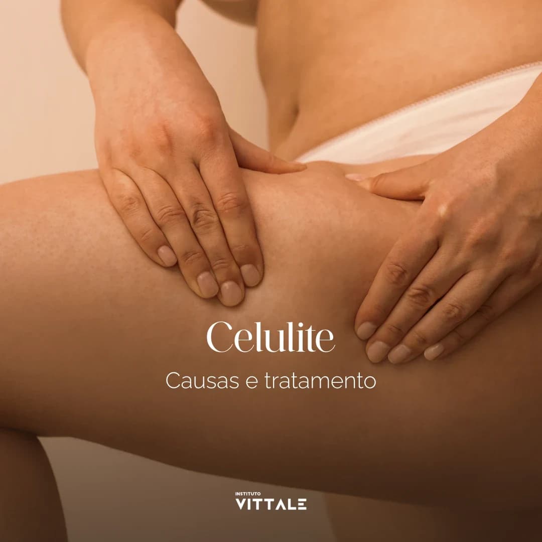 Post educativo sobre causas e tratamento de celulite do Instituto Vittale