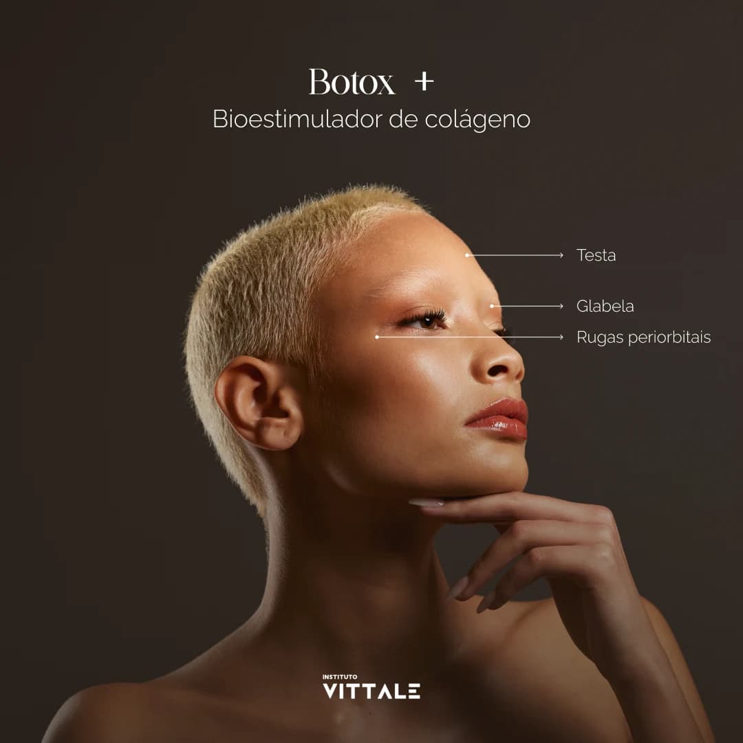 Post educativo sobre regiões de aplicação de botox e bioestimulador de colágeno